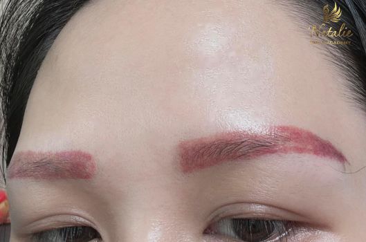 xoa-laser-long-may-bi-do-co-sao-khong (3)